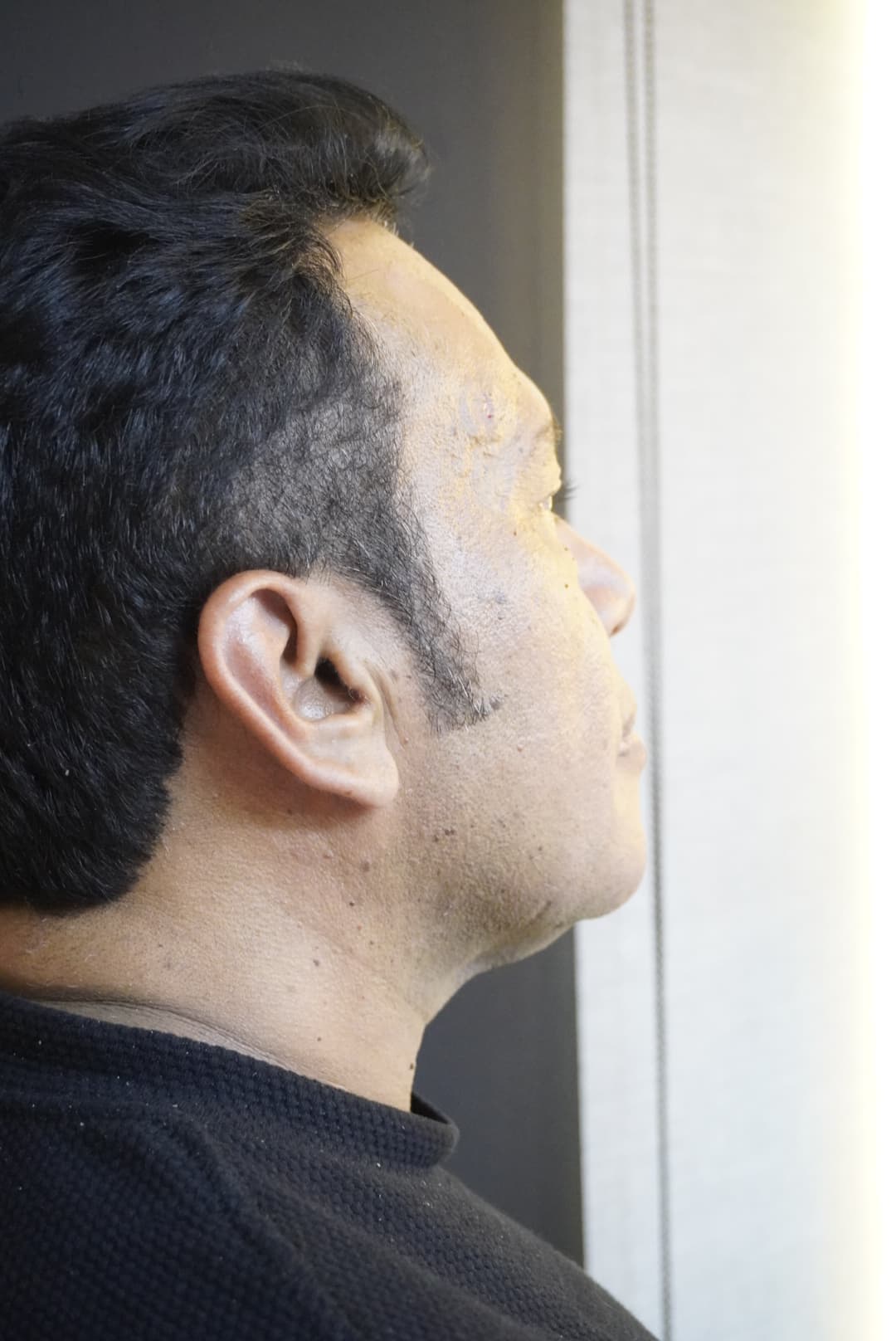 Ozempic face: perda rápida de peso aumenta busca por tratamentos para flacidez facial