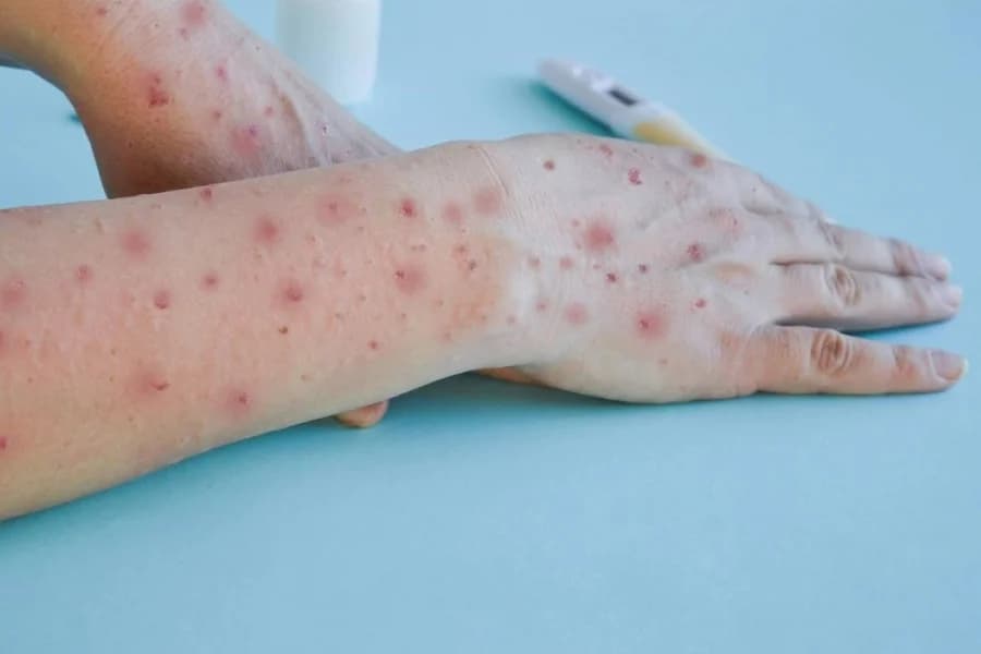 Ceará confirma segundo caso de mpox em 2026 e reforça vigilância epidemiológica