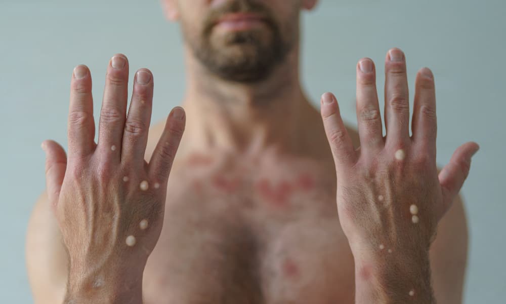 Brasil contabiliza 140 casos de mpox registrados em 2026